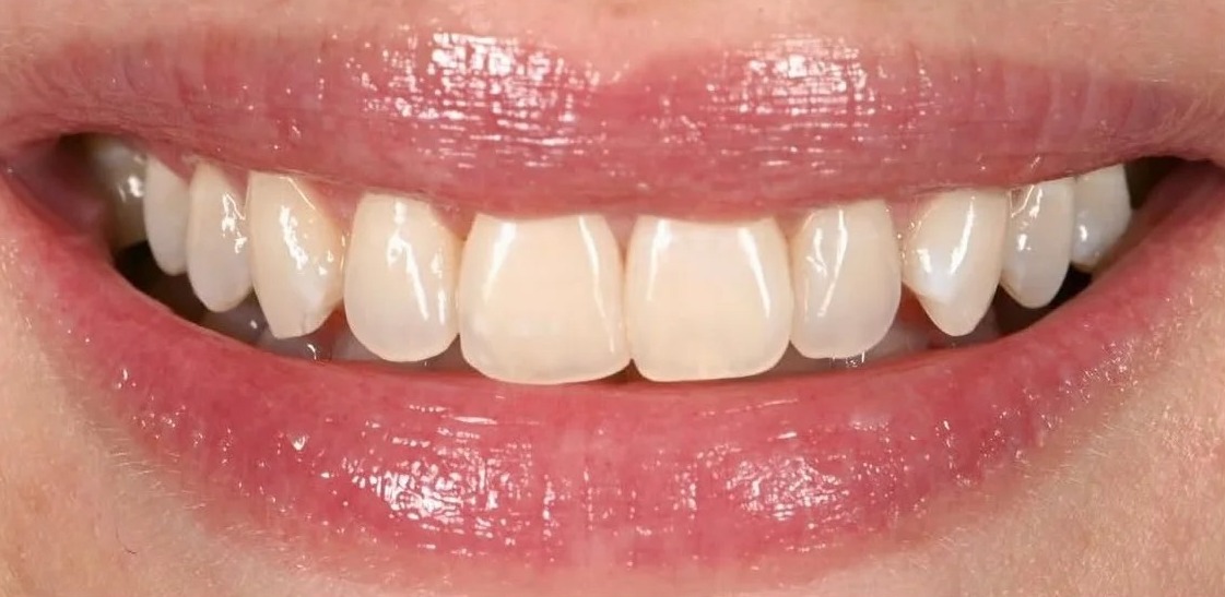 Before: After treatment: artistic composite bonding used to repair localized structural damage, achieving an undetectable margin and perfectly mimicking the translucency and texture of the adjacent natural enamel.