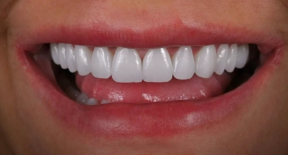 After: Full transformation: before treatment, discoloration along the gumline and minor spacing detracted from the smile; after treatment, custom porcelain veneers delivered ideal length, subtle translucency, and natural vitality for a highly sophisticated aesthetic.