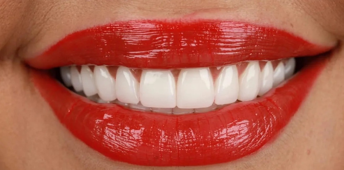 After: Full transformation: before treatment, the smile exhibited misalignment, crowding, and dullness; after treatment, cosmetic alignment paired with expert whitening yielded properly positioned, vibrant teeth with healthy, natural contours.