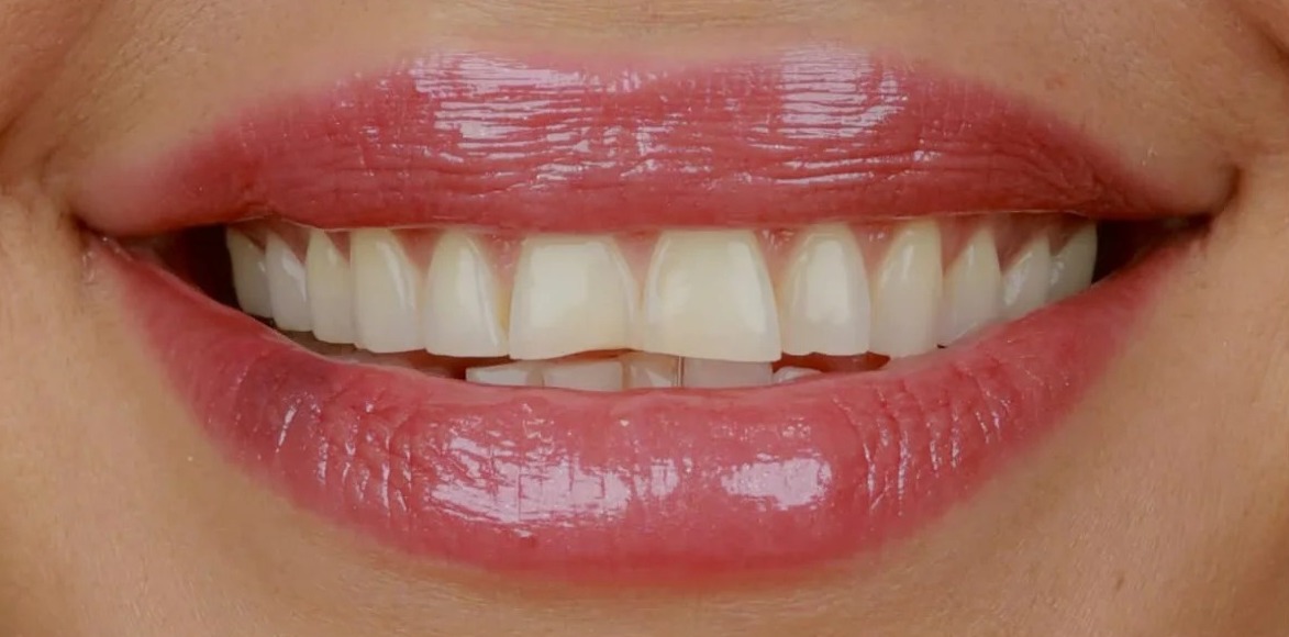 Before: Full transformation: before treatment, the smile exhibited misalignment, crowding, and dullness; after treatment, cosmetic alignment paired with expert whitening yielded properly positioned, vibrant teeth with healthy, natural contours.