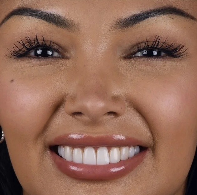 Before: Full transformation: before treatment, the smile lacked brightness and balance; after treatment, a personalized cosmetic plan using custom porcelain restorations delivered luminous vitality and precise contouring in harmony with the patient's facial features.