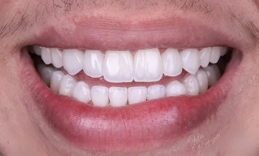 After: Full transformation: before treatment, the smile lacked proper symmetry and exhibited age-related discoloration; after treatment, restorative cosmetic dentistry provided properly aligned, vibrant ceramic restorations with natural texture.