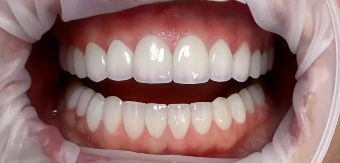 After: Full transformation: before treatment, the teeth showed widespread discoloration and surface staining across both arches; after treatment, comprehensive ceramic restorations delivered a bright, uniform, and naturally vital smile.