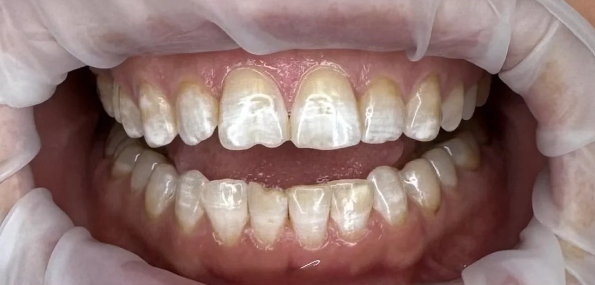 Before: Full transformation: before treatment, the teeth showed widespread discoloration and surface staining across both arches; after treatment, comprehensive ceramic restorations delivered a bright, uniform, and naturally vital smile.
