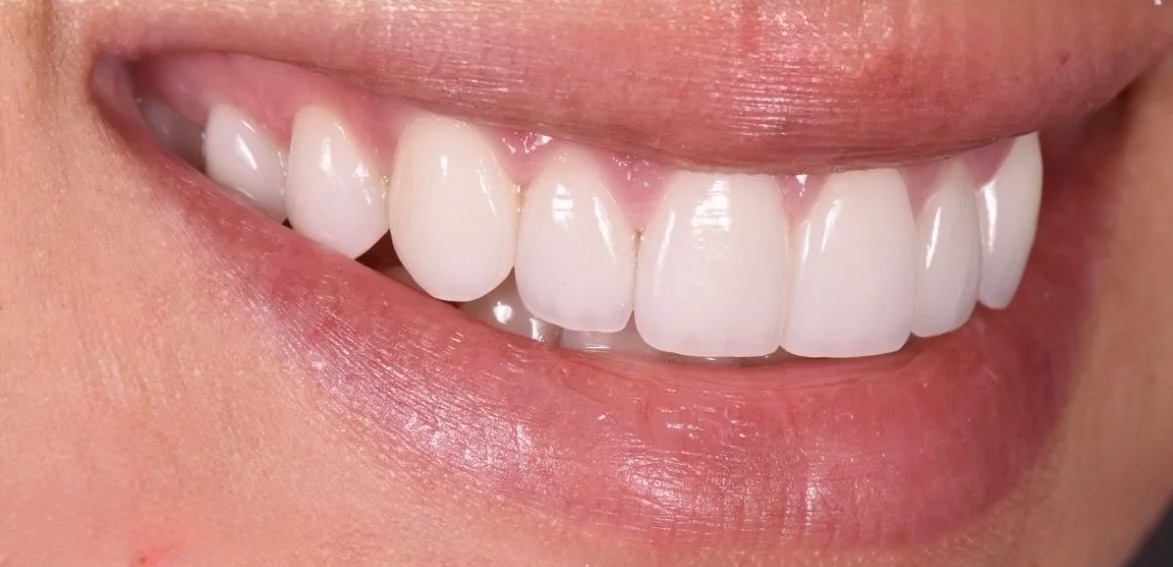 After: Full transformation: before treatment, uneven edges and spacing interrupted the smile line; after treatment, ultra-thin porcelain veneers with careful internal layering reflect light with the exact translucency and vitality of natural, healthy dental enamel.