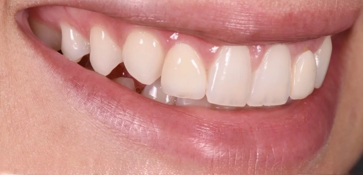 Before: Full transformation: before treatment, uneven edges and spacing interrupted the smile line; after treatment, ultra-thin porcelain veneers with careful internal layering reflect light with the exact translucency and vitality of natural, healthy dental enamel.