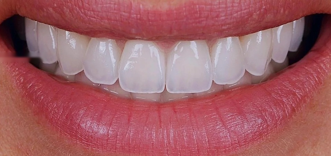 After: Full transformation: before treatment, old, discolored bonding and subtle gaps created an uneven appearance; after treatment, custom porcelain veneers seamlessly closed the spaces, restoring proper contouring and a vibrant, youthful vitality to the smile.