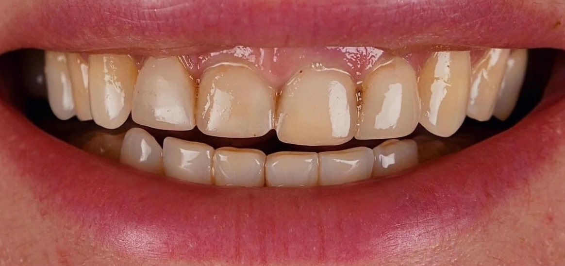 Before: Full transformation: before treatment, old, discolored bonding and subtle gaps created an uneven appearance; after treatment, custom porcelain veneers seamlessly closed the spaces, restoring proper contouring and a vibrant, youthful vitality to the smile.