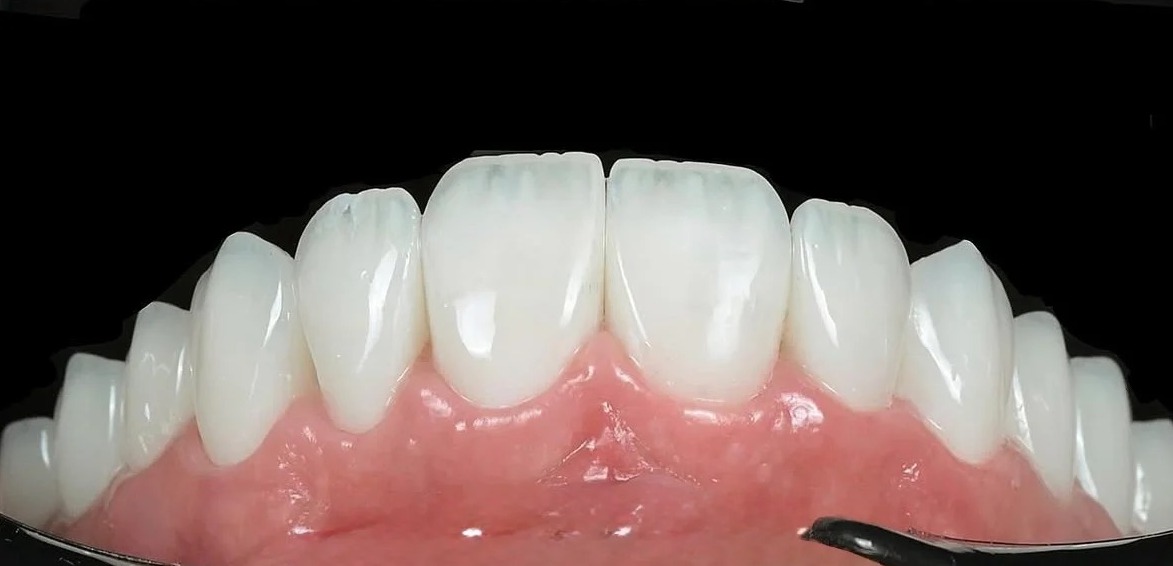 After: After treatment: custom ceramic restorations designed with meticulous attention to the micro-details of tooth anatomy, including natural surface texture, ideal incisal translucency, and proper embrasure spaces.