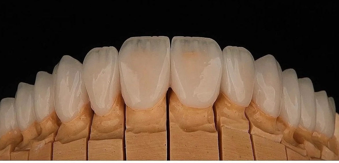 Before: After treatment: custom ceramic restorations designed with meticulous attention to the micro-details of tooth anatomy, including natural surface texture, ideal incisal translucency, and proper embrasure spaces.
