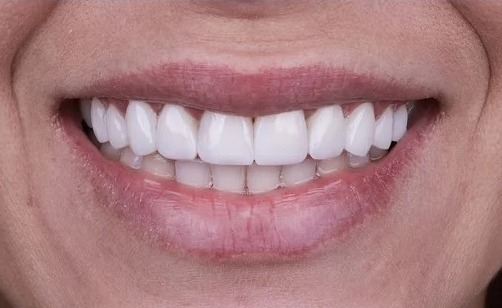 Before: Full transformation: before treatment, the teeth exhibited significant wear, loss of vertical dimension, and yellowing; after treatment, a full-arch rehabilitation utilizing custom ceramic restorations completely restored proper function, symmetry, and vibrant aesthetics.