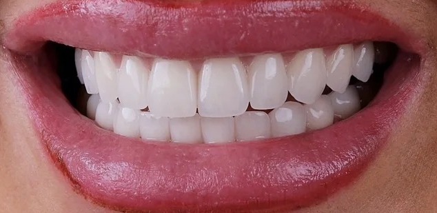 After: Full transformation: before treatment, the patient presented with old, discolored restorations and an uneven gum line; after treatment, modern metal-free ceramic crowns provided a highly cohesive, naturally contoured, and vital appearance.