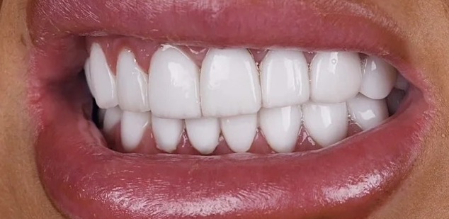 Before: Full transformation: before treatment, the patient presented with old, discolored restorations and an uneven gum line; after treatment, modern metal-free ceramic crowns provided a highly cohesive, naturally contoured, and vital appearance.