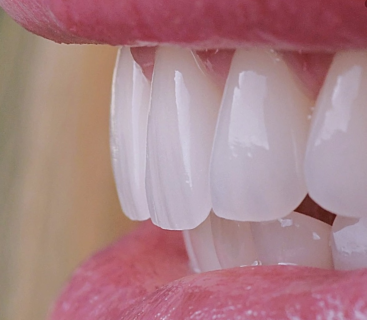 After: Full transformation: before treatment, aging, bulky, opaque veneers created an unnatural appearance and lacked the beauty and vitality of natural teeth; after treatment, custom ceramic restorations were crafted to mimic the translucency, texture, and vitality of healthy natural teeth.