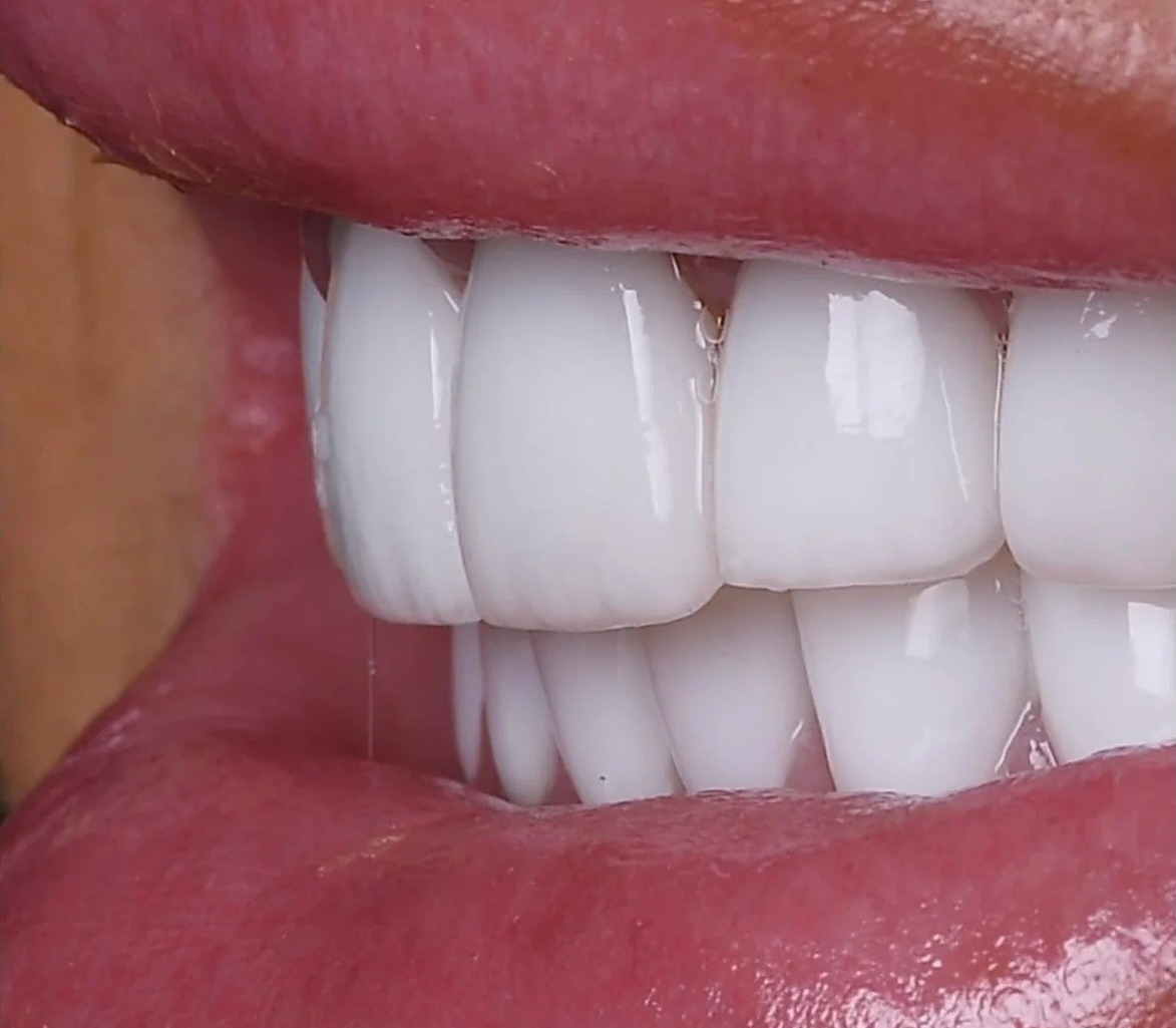 Before: Full transformation: before treatment, aging, bulky, opaque veneers created an unnatural appearance and lacked the beauty and vitality of natural teeth; after treatment, custom ceramic restorations were crafted to mimic the translucency, texture, and vitality of healthy natural teeth.
